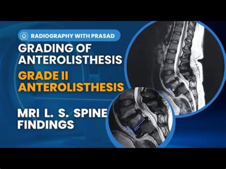 Anterolistese - How To Discuss