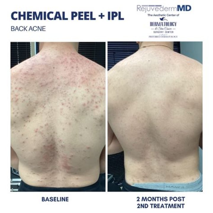 Bacne scars - How To Discuss