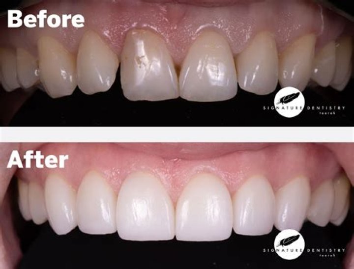Bad veneers before and after