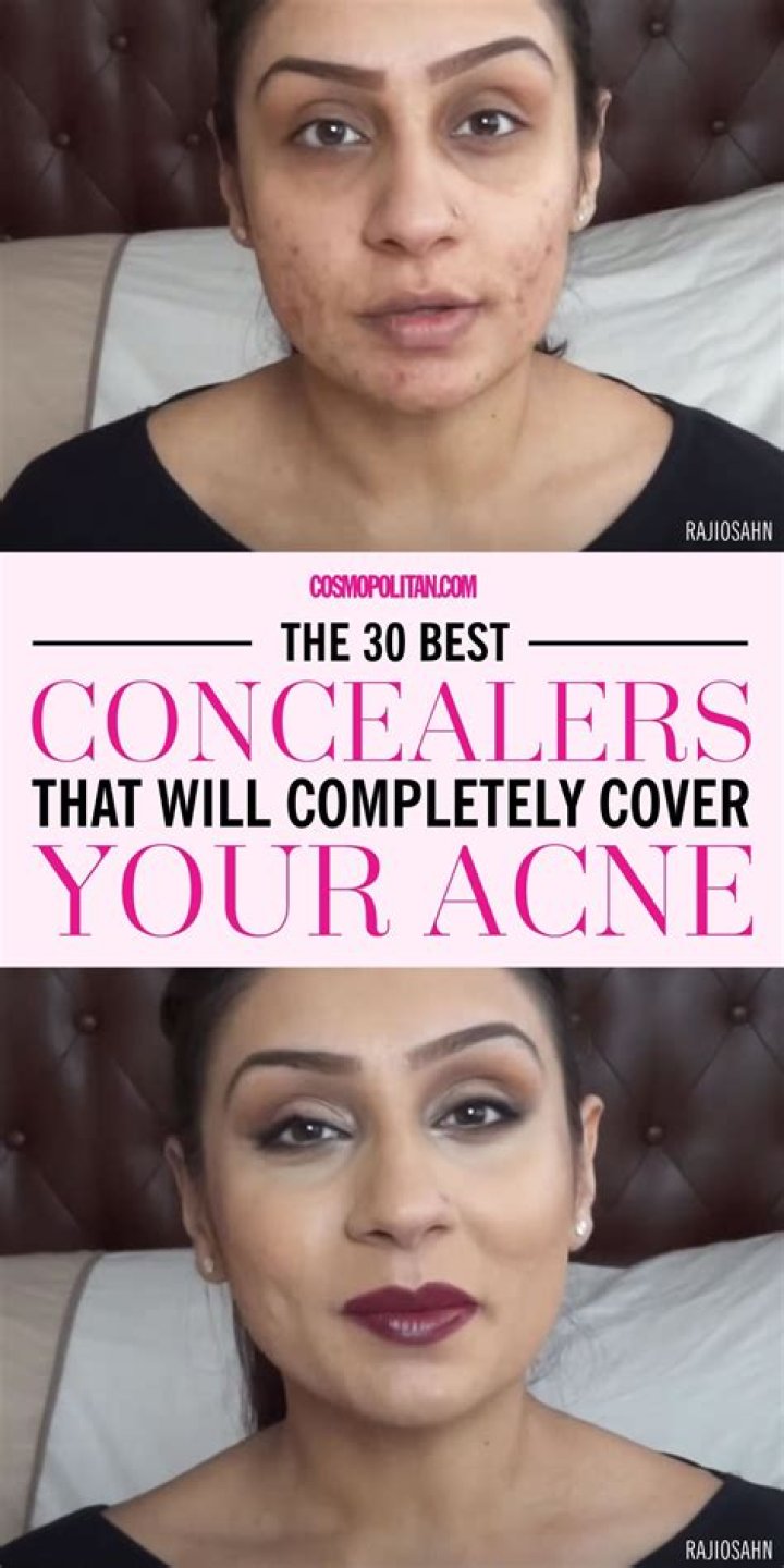 Best concealer for acne - How To Discuss