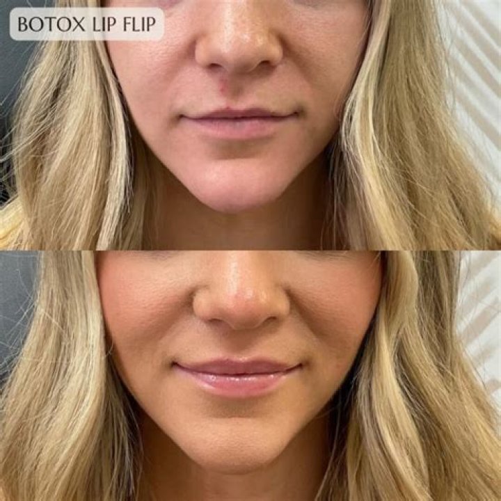 Botox upper lip - How To Discuss