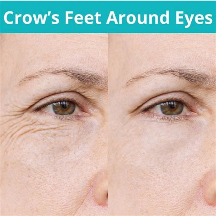 Crows feet eyes - How To Discuss