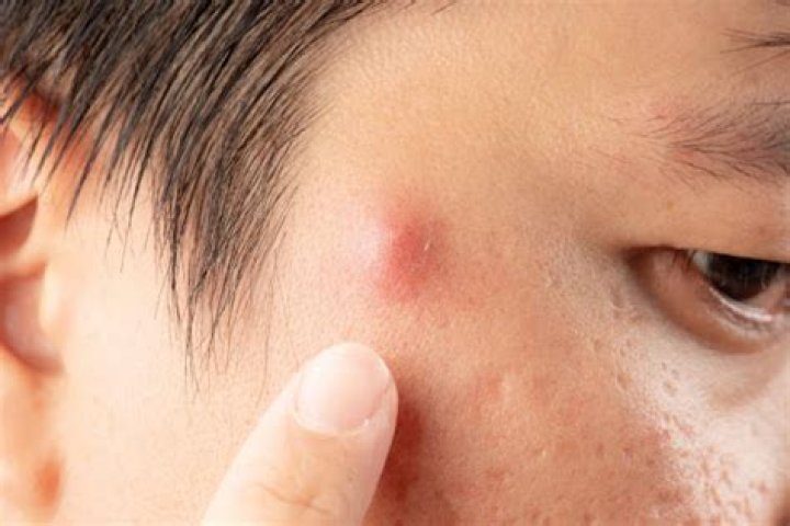 Cystic acne on forehead - How To Discuss