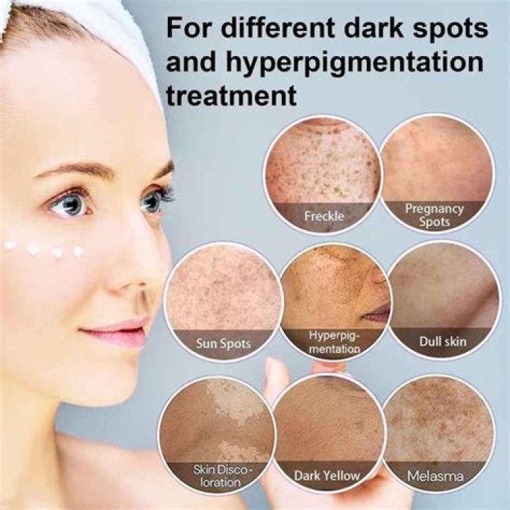 Dark spot cream - How To Discuss