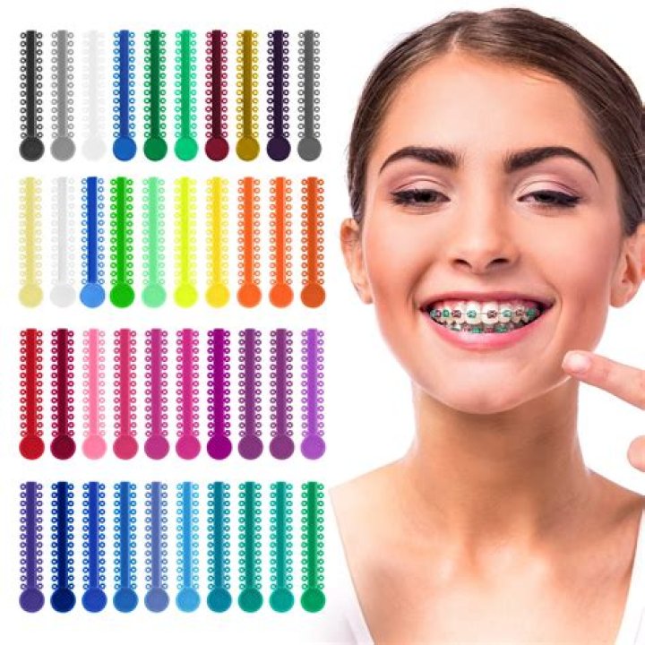 Do You Have To Get Molds For Braces