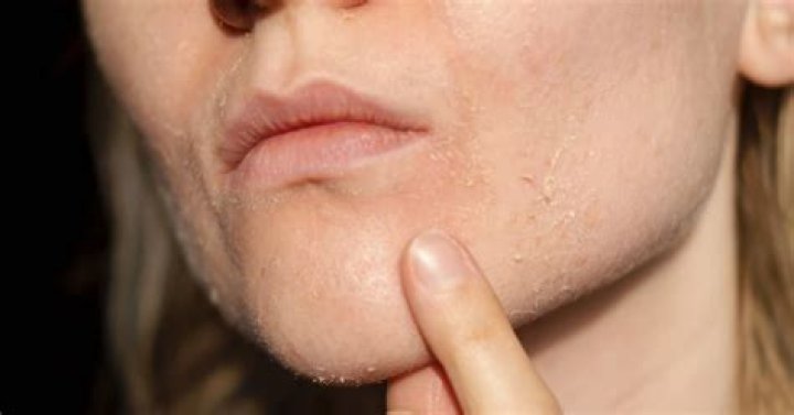 Dry skin around mouth - How To Discuss