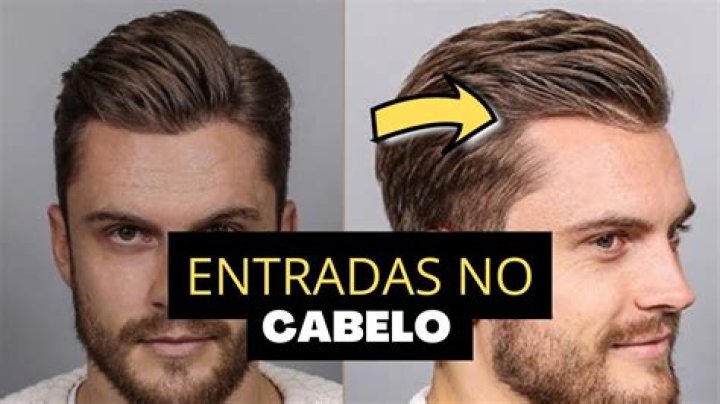 Entradas No Cabelo - How To Discuss