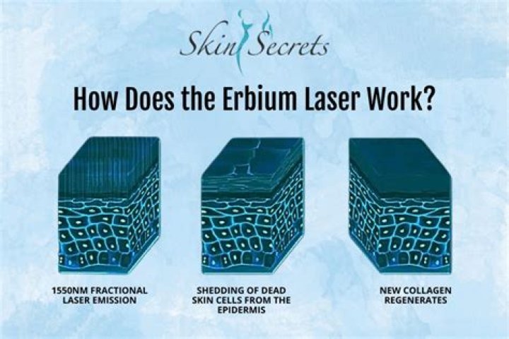 Erbium laser - How To Discuss