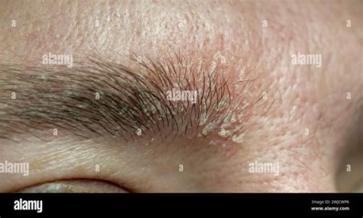 Eyebrow eczema - How To Discuss