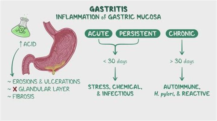 Gastritis Icd 10 - How To Discuss