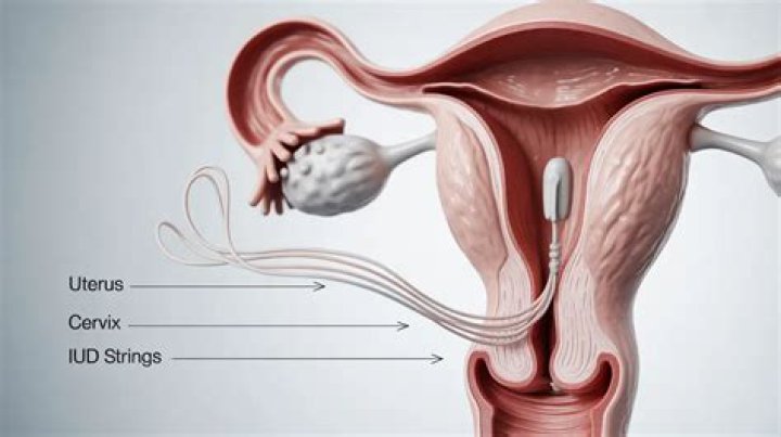 How Long Does It Take For Iud Strings To Soften
