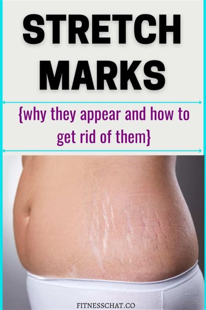 How to reduce stretch marks