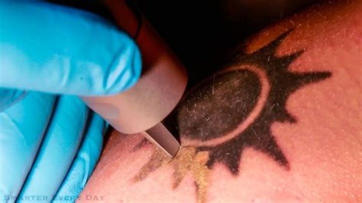 How To Remove A Tattoo With Salt And Ice