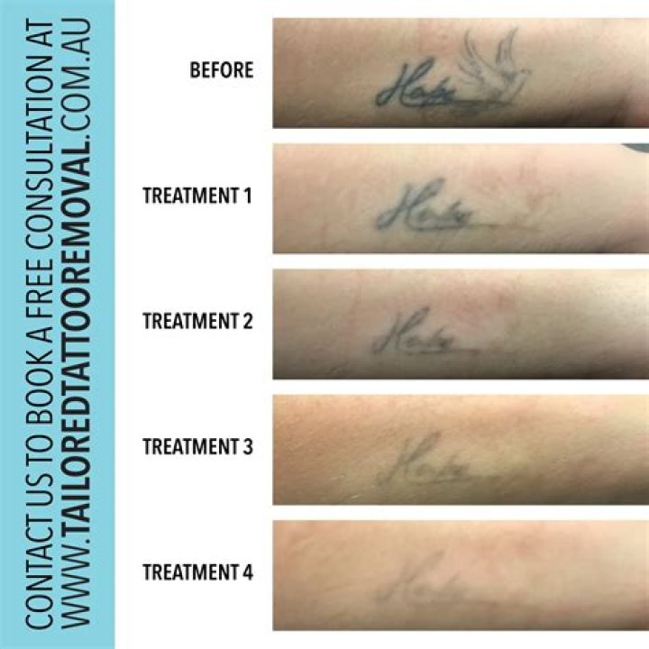 Hydrogen Peroxide Tattoo Removal - How To Discuss