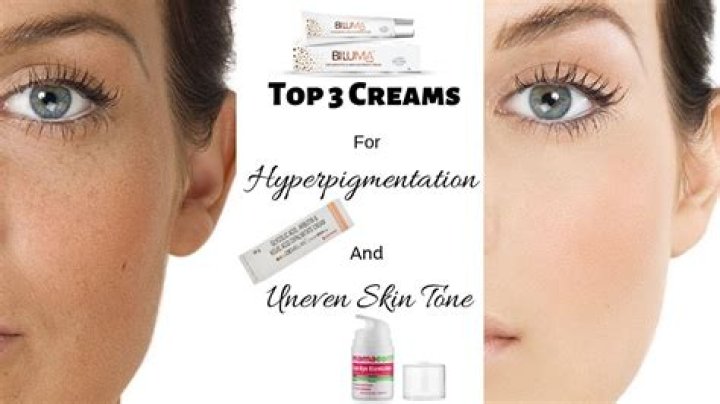 Hyperpigmentation cream - How To Discuss