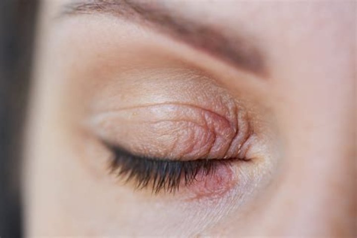 Itchy skin around eyes - How To Discuss
