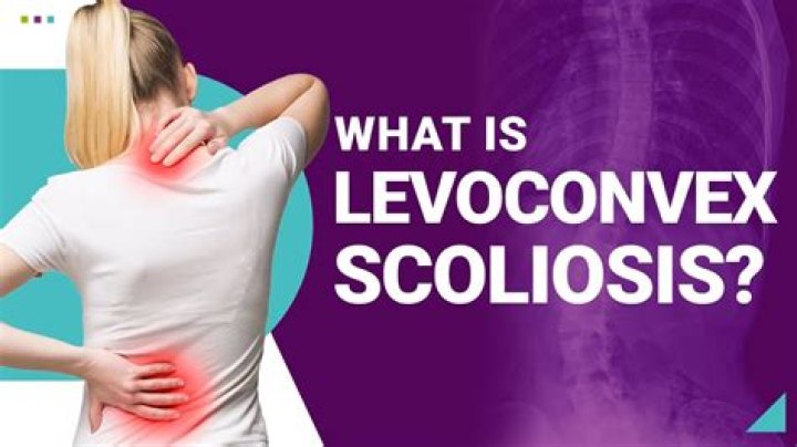 Levoconvex Scoliosis - How To Discuss
