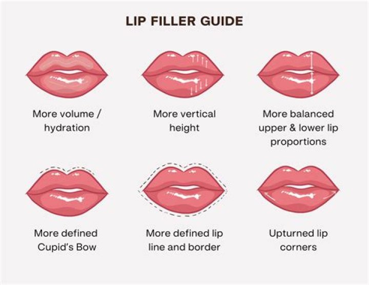 Lip filler - How To Discuss