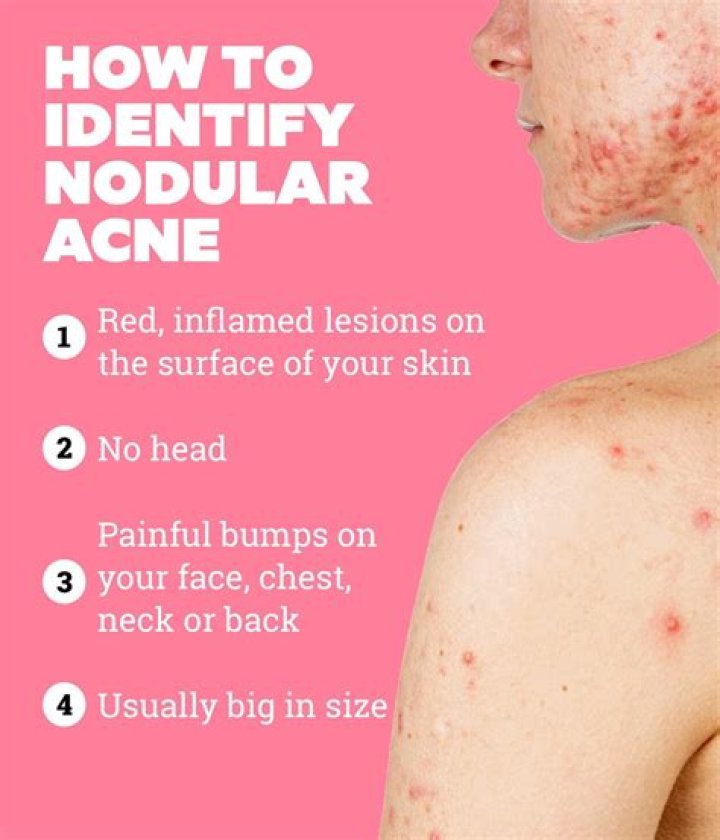 Nodular acne treatment - How To Discuss