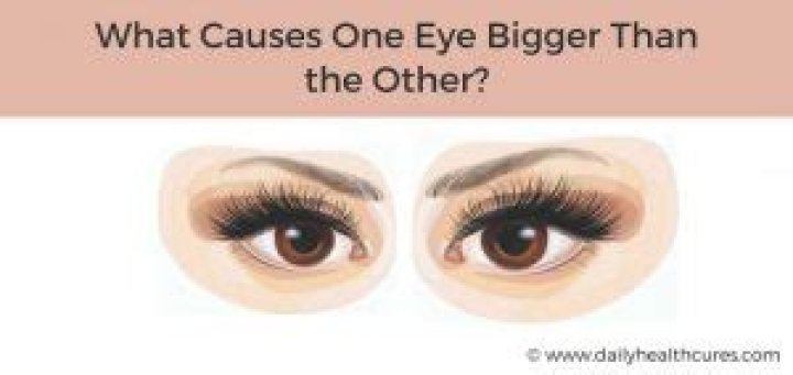 One eye bigger than the other