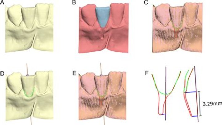 Pale recession - How To Discuss