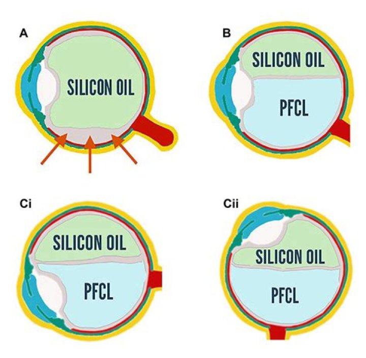 Perfluorocarbon (PFC) - How To Discuss