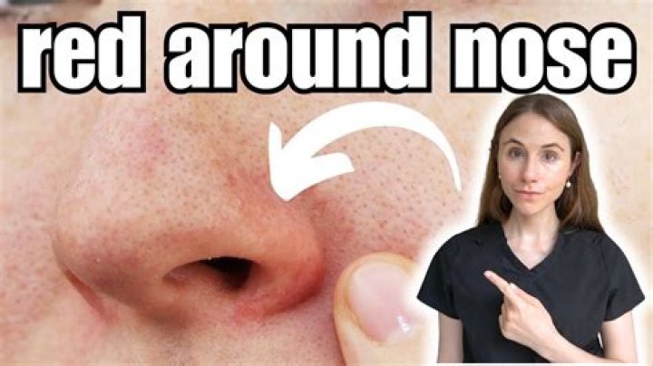 Red Line On Nose - How To Discuss