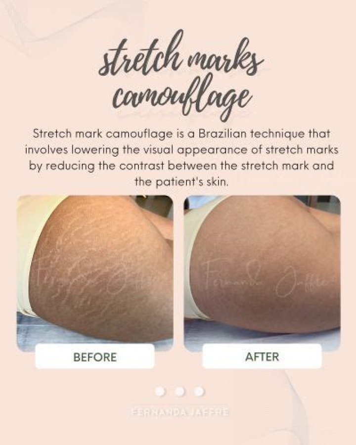 Stretch mark tattoo camouflage - How To Discuss