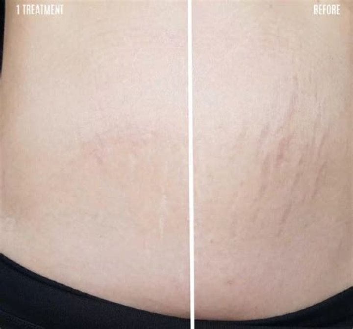 Stretch marks on face - How To Discuss