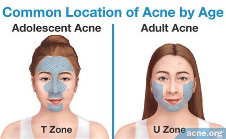 T zone acne - How To Discuss