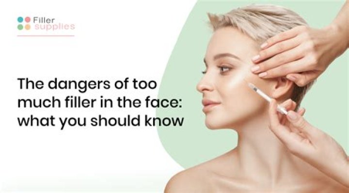 Too much cheek filler - How To Discuss