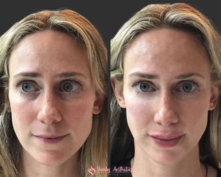 Under eye filler before and after