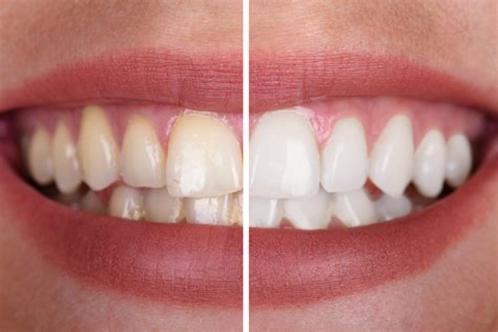 Zoom whitening before and after